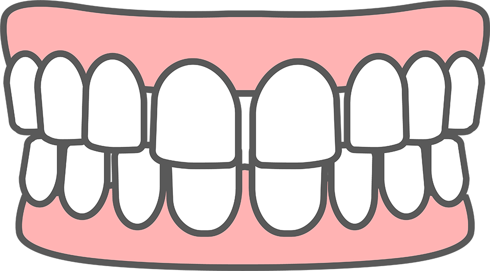歯の間の隙間が気になるすきっ歯「空隙歯列・正中離開」