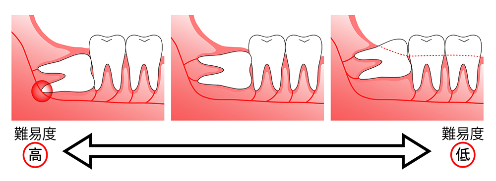 親知らずの抜歯のリスクについて