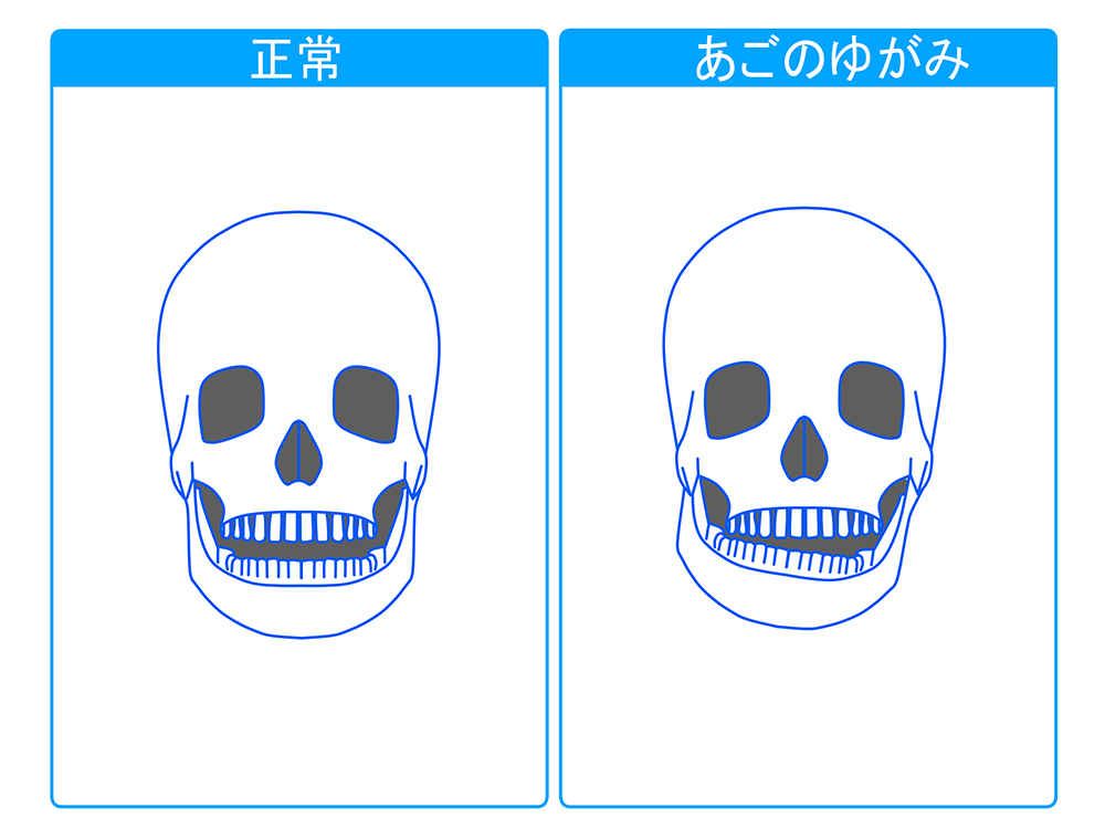 顎の関節が痛い『顎関節症』とは？