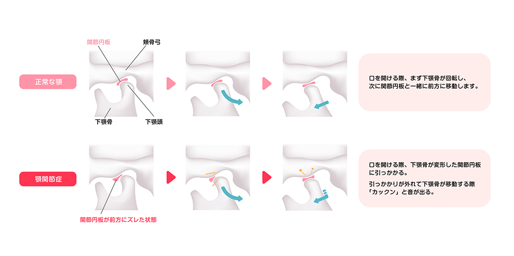 顎関節症の原因