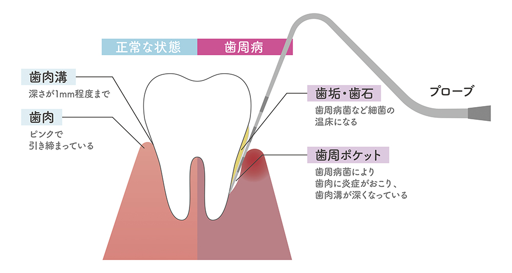 なぜ「歯周病」になってしまうのか？