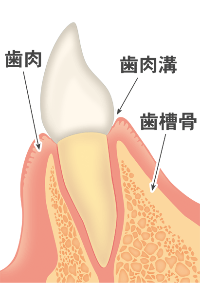 歯周病の進行段階