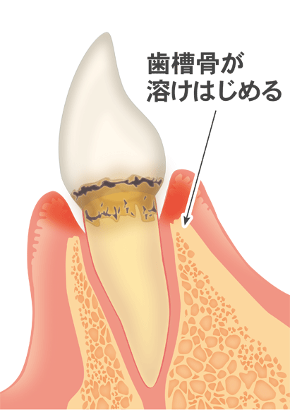 進行度2：軽度歯周炎