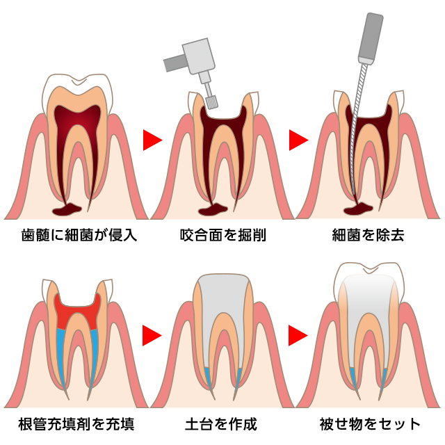 重度のむし歯でも歯を残せる可能性がある『根管治療』とは